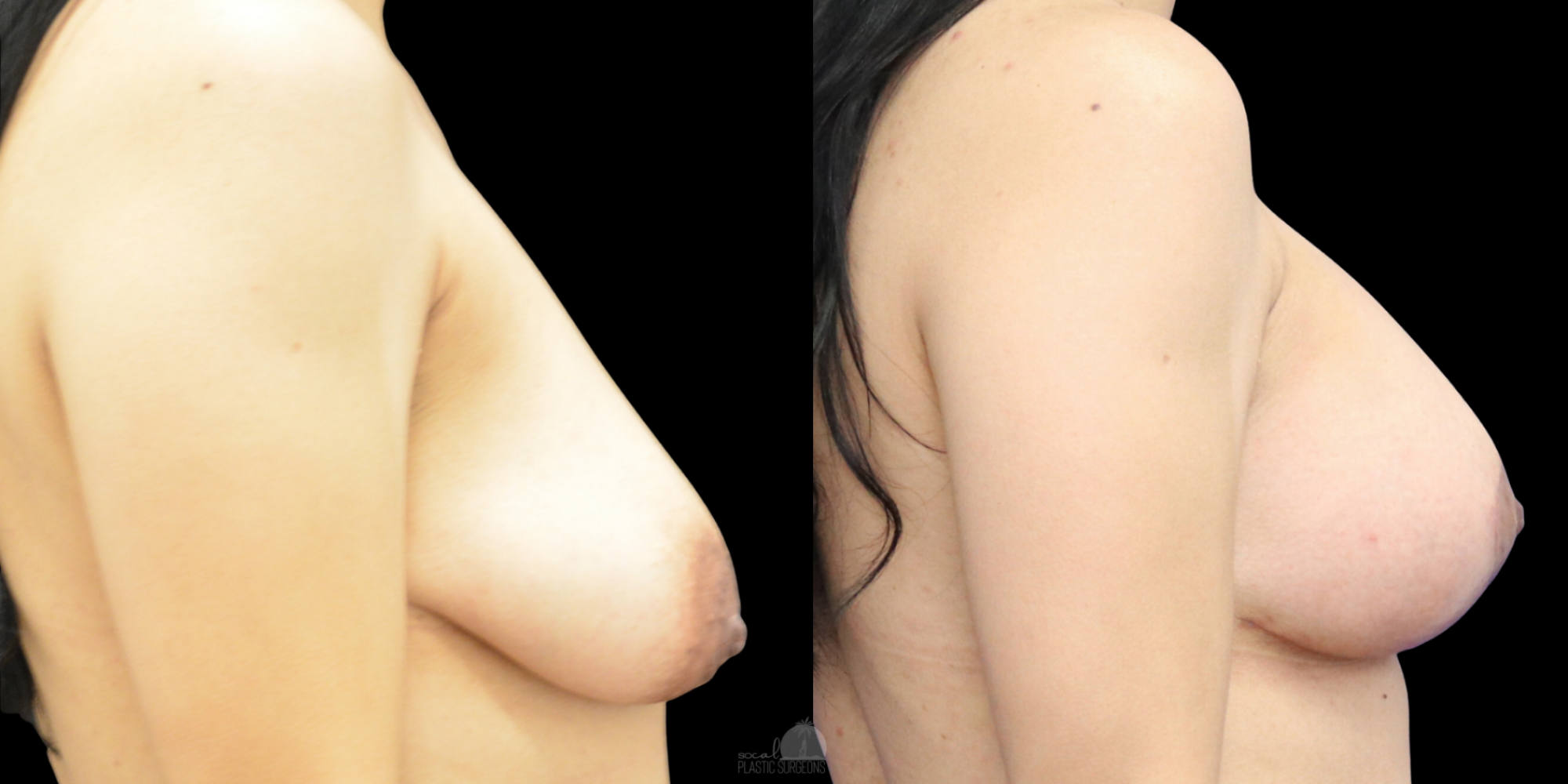 Mastopexy before and after