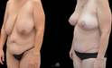 Mommy Makeover Before and after