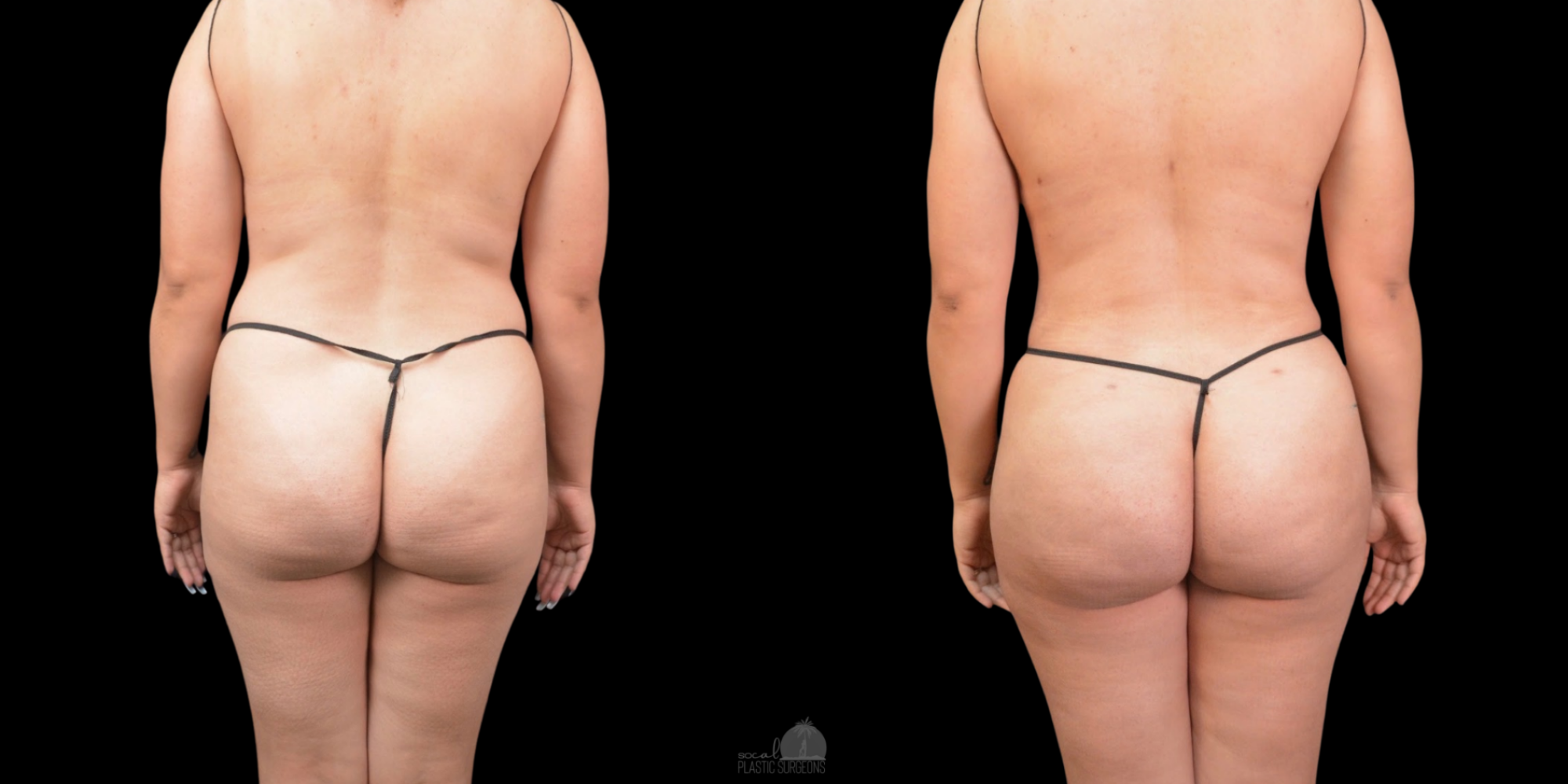 before and after body contouring