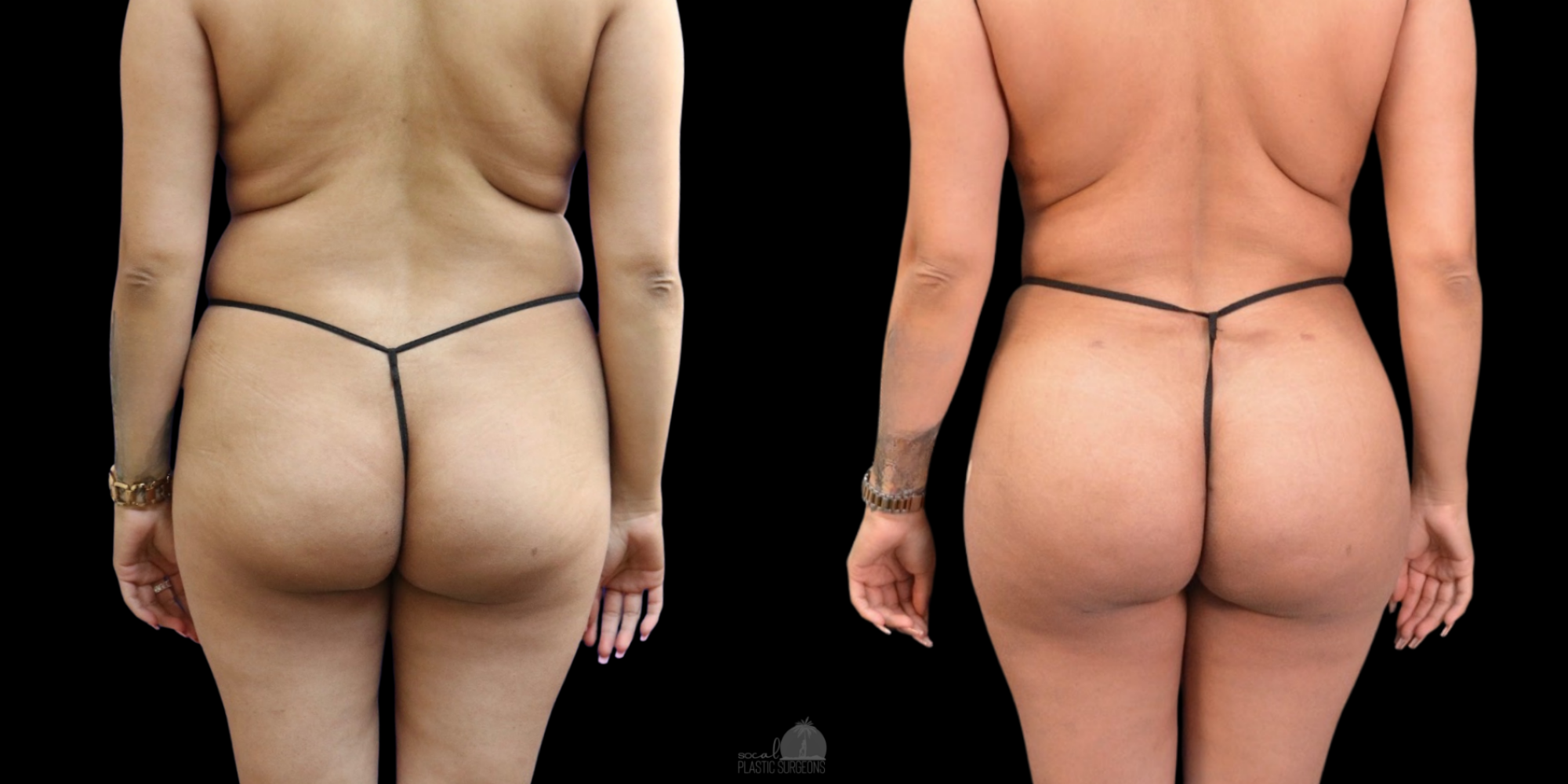 Skinny BBL before and after and lipo 360