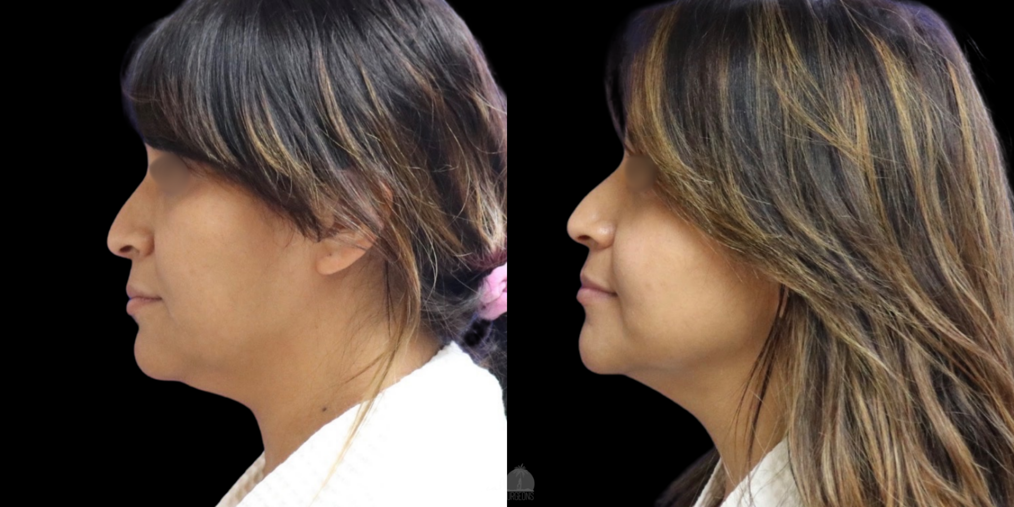 Side-by-side profile comparisons of a woman before and after cosmetic surgery, showing improved chin and neck contour.
