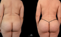 Mommy Makeover Before and after white woman