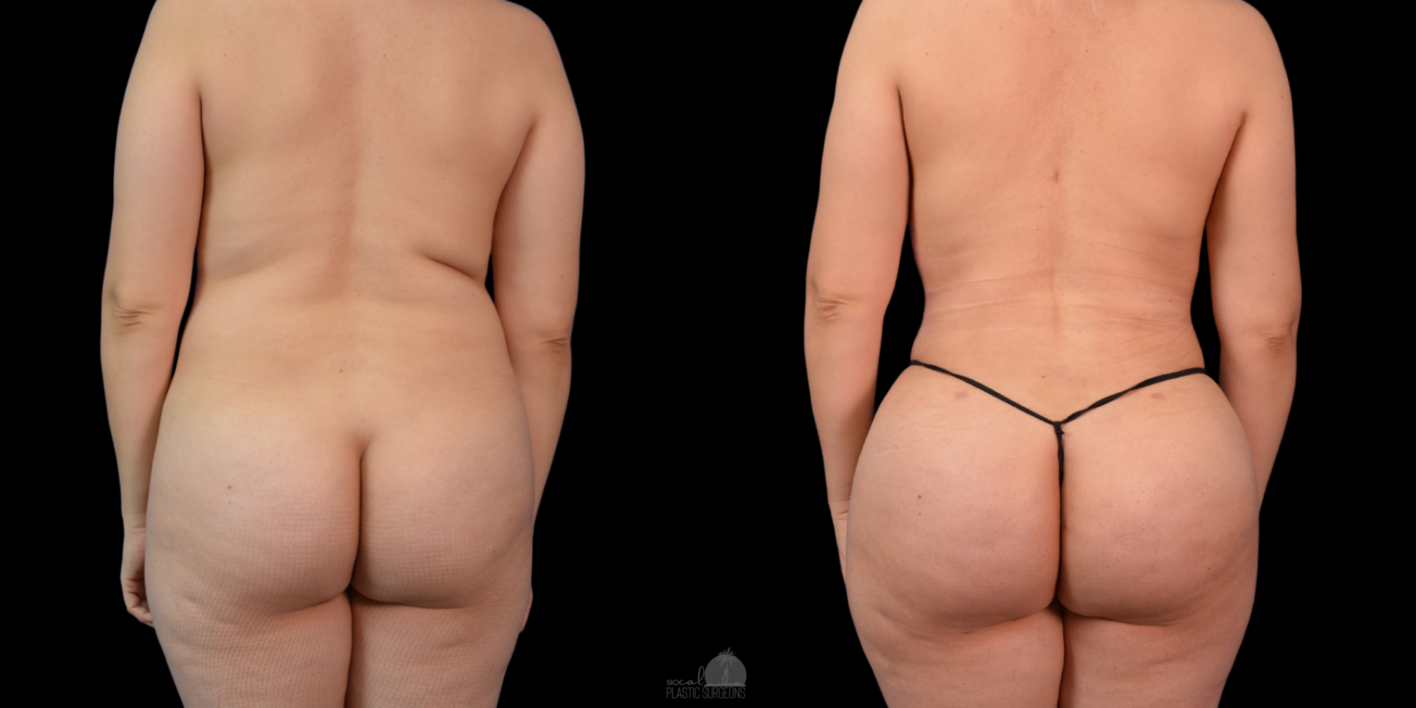 Mommy Makeover Before and after white woman