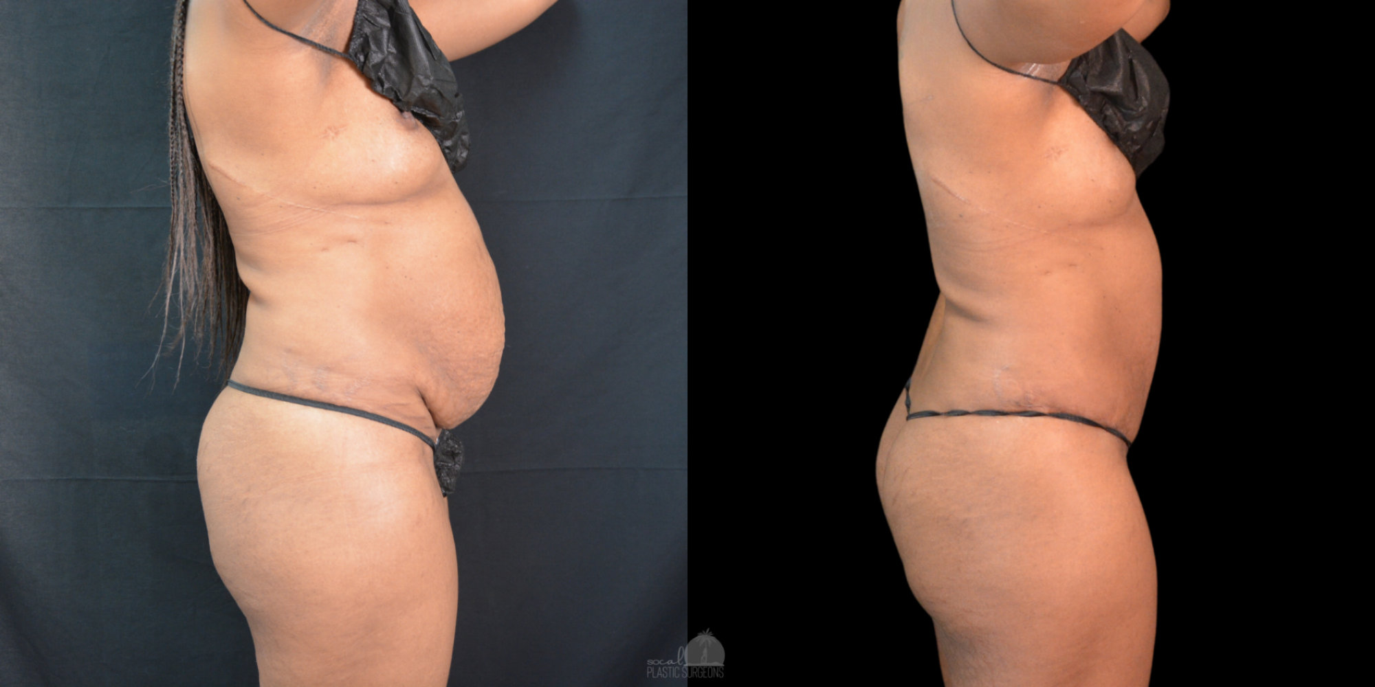 Side-by-side images before and after mommy make over