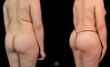 Mommy Makeover Before and after white woman