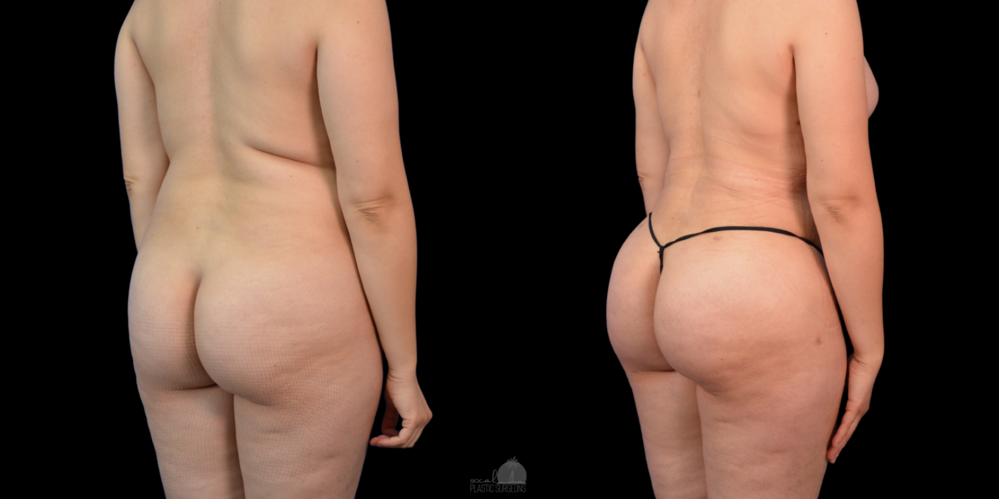 Mommy Makeover Before and after white woman