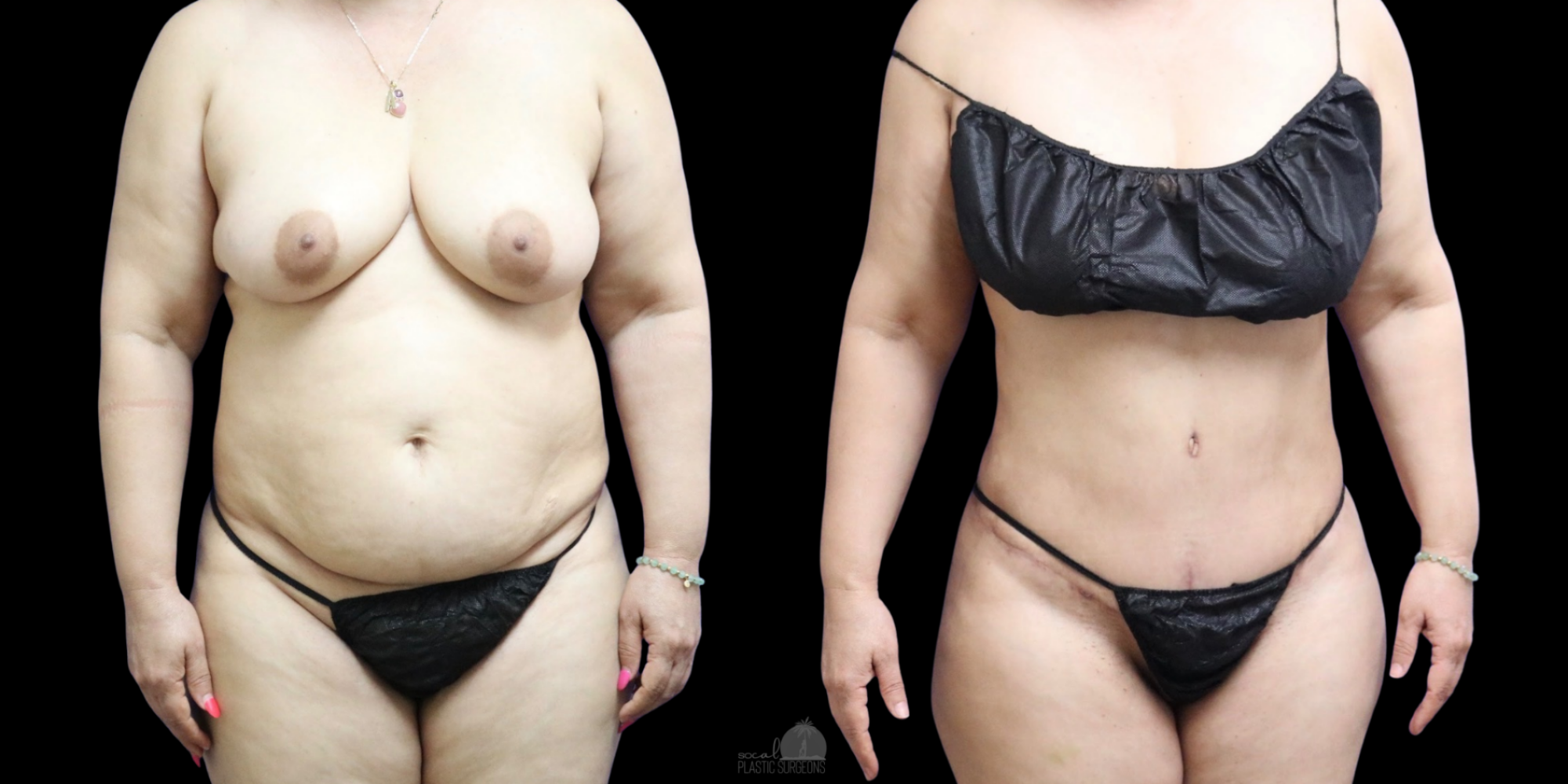 mommy makeover recovery before and after