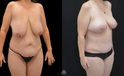Mommy Makeover Before and after