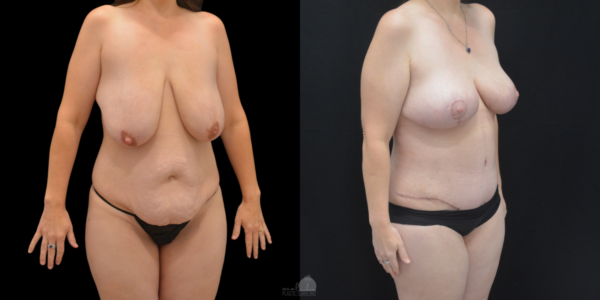 Mommy Makeover Before and after