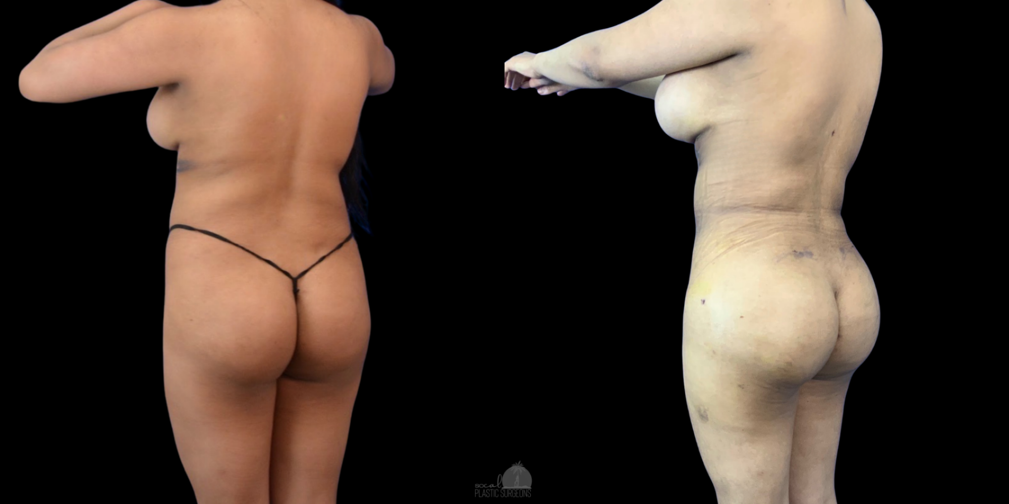 BBL Before and after woman