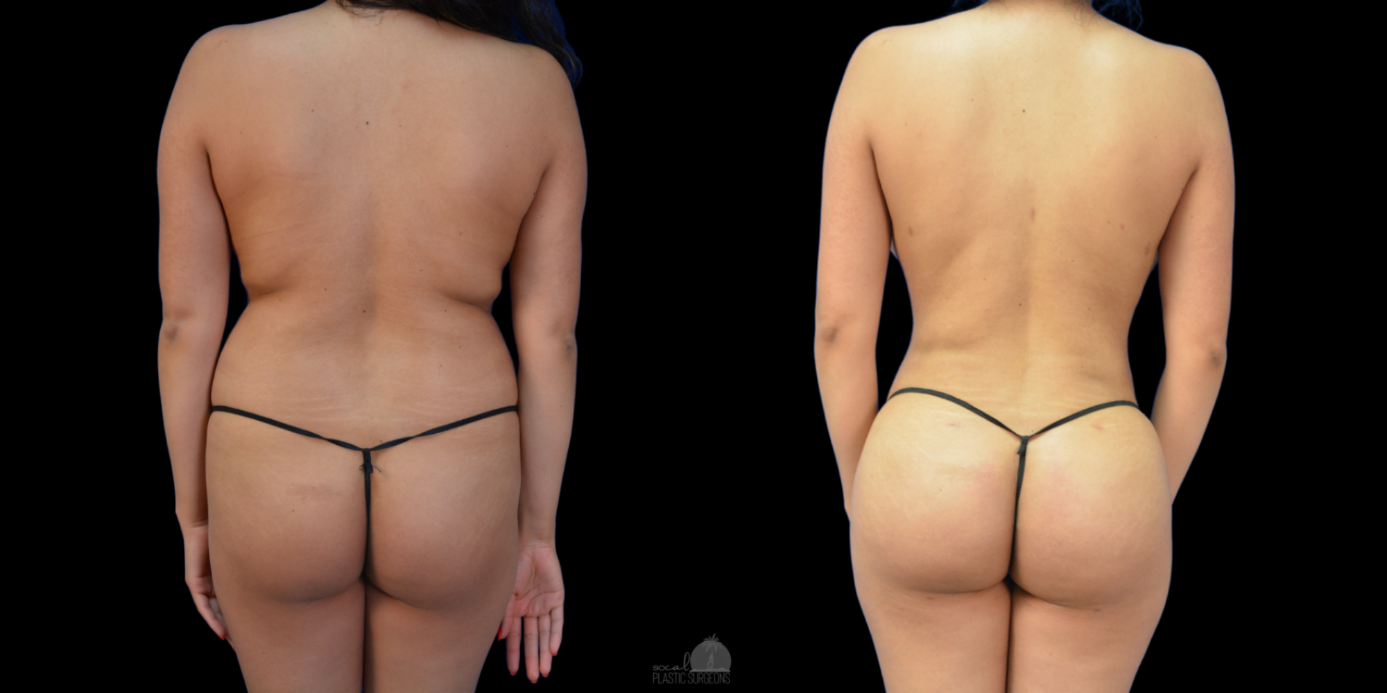 BBL BEFORE & AFTER abd Lipo 360 in flanks