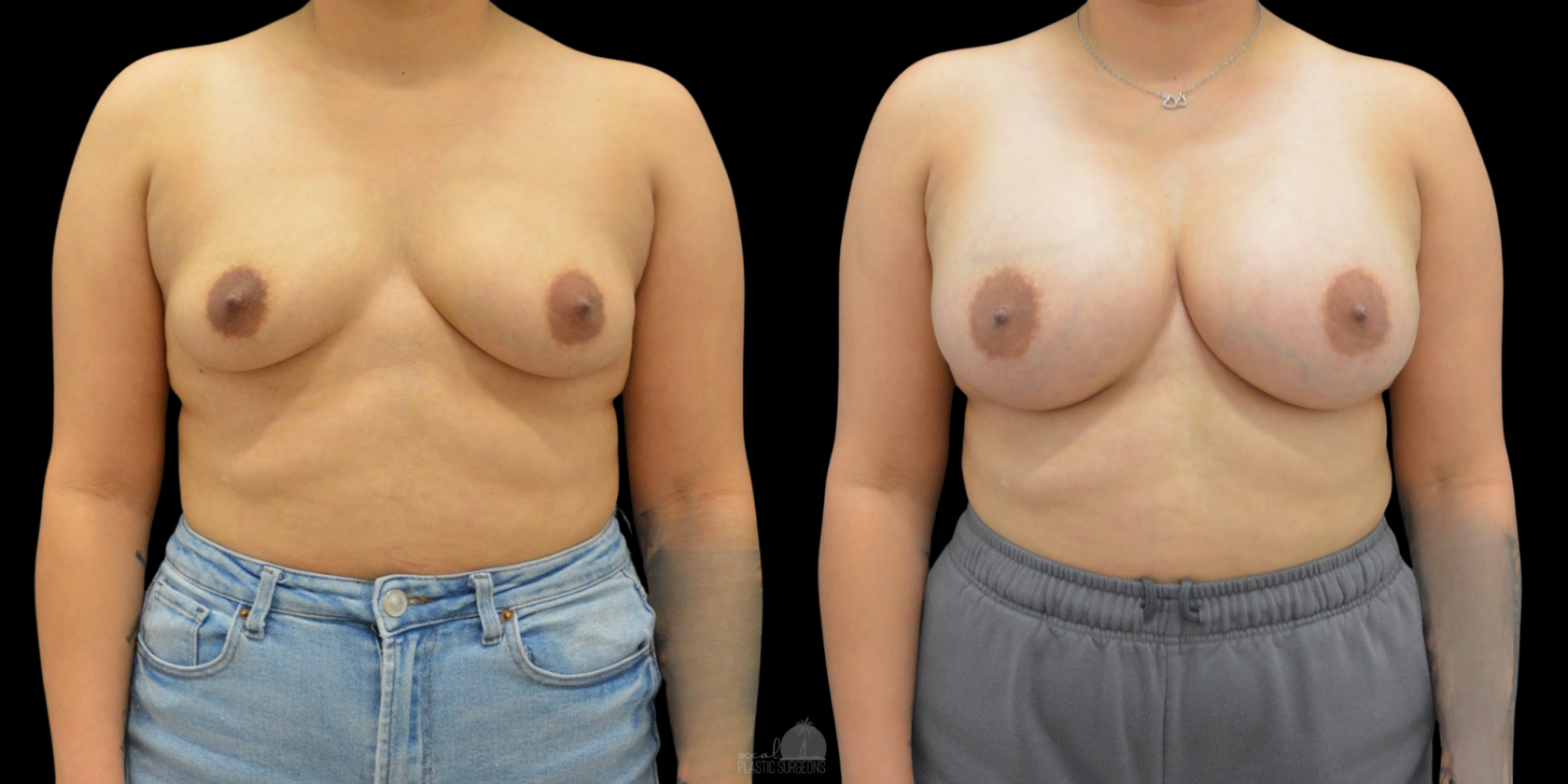 BREAST AUG BEFORE & AFTER