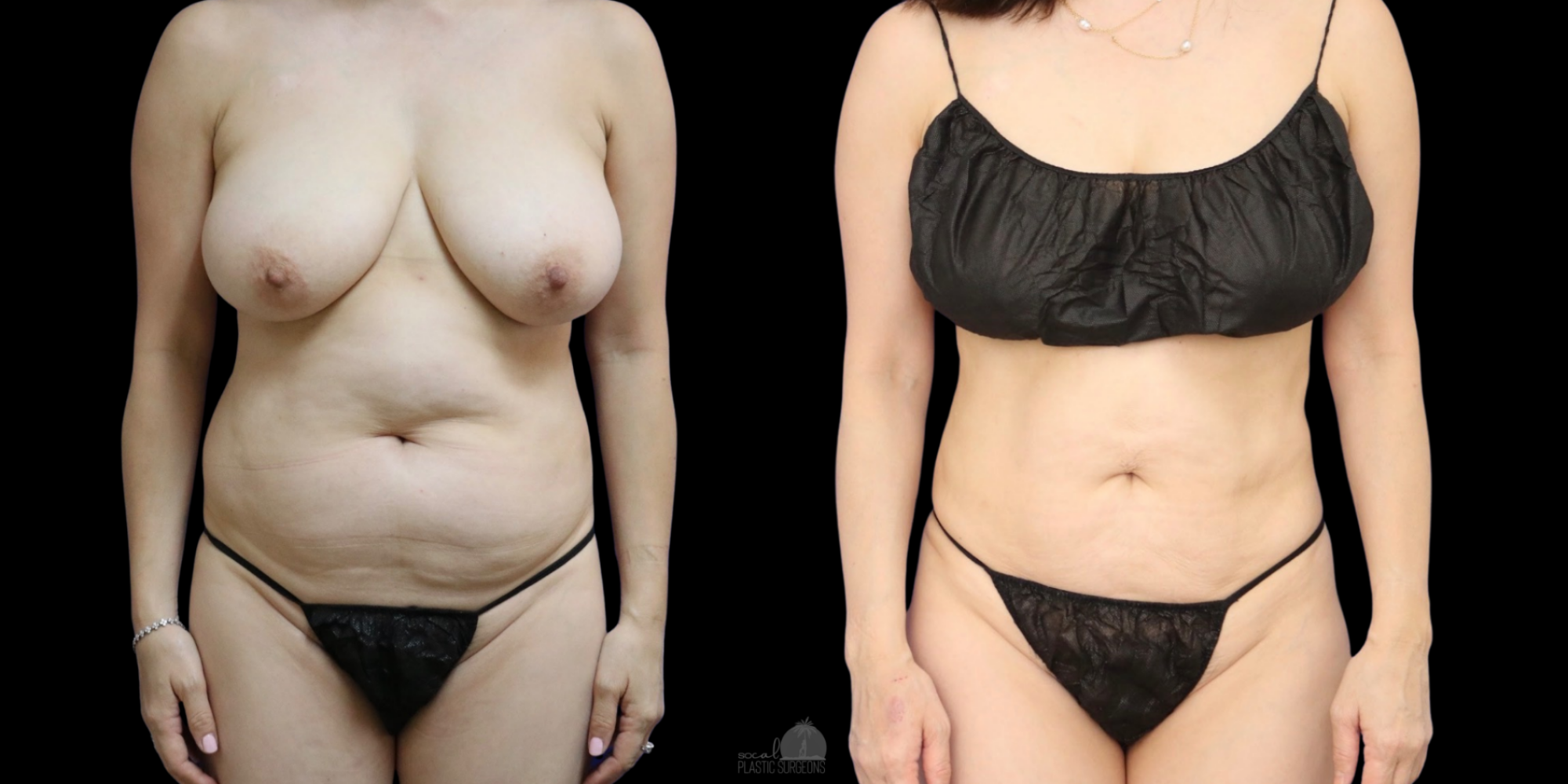 VASER BEFORE & AFTER woman