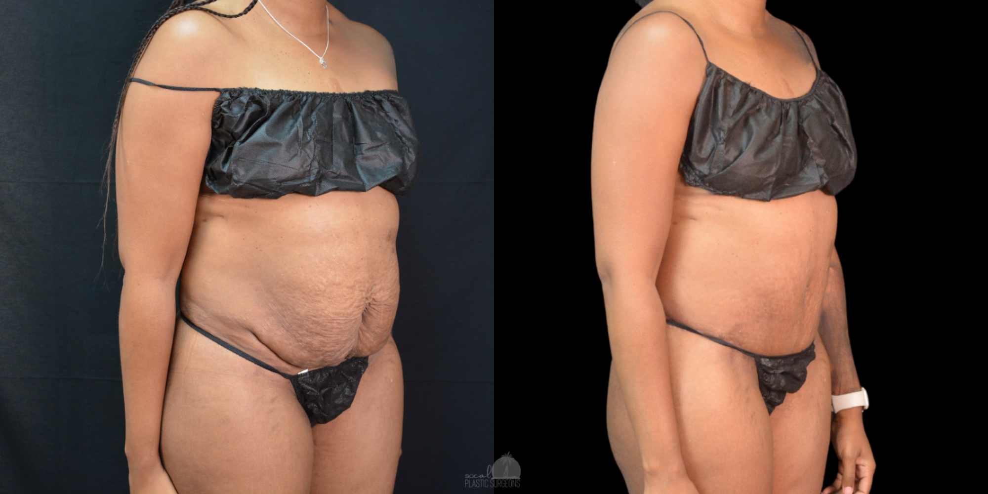 Side-by-side images before and after mommy make over