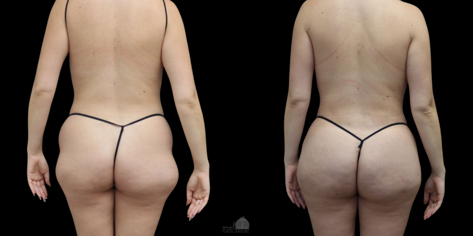 LIPO 360 BEFORE & AFTER and BBL before and after