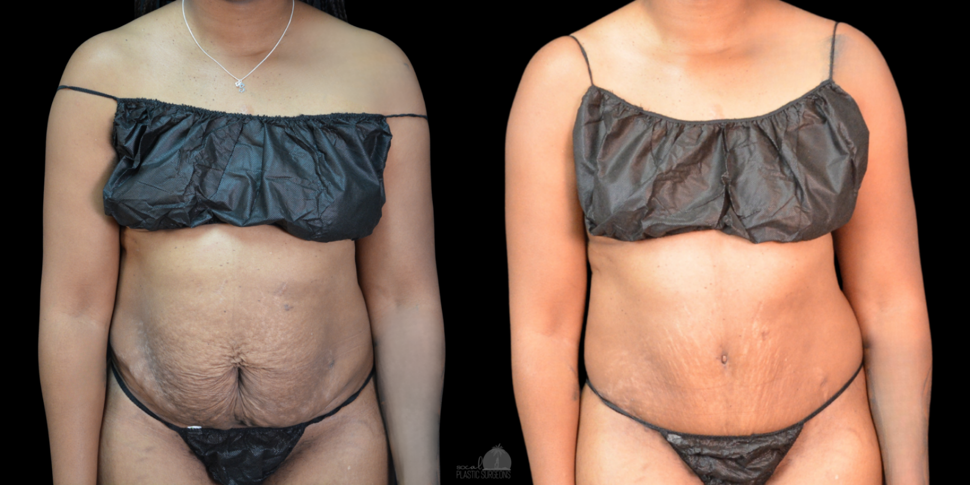 Side-by-side images before and after mommy make over