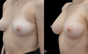 breast augmentation before and after