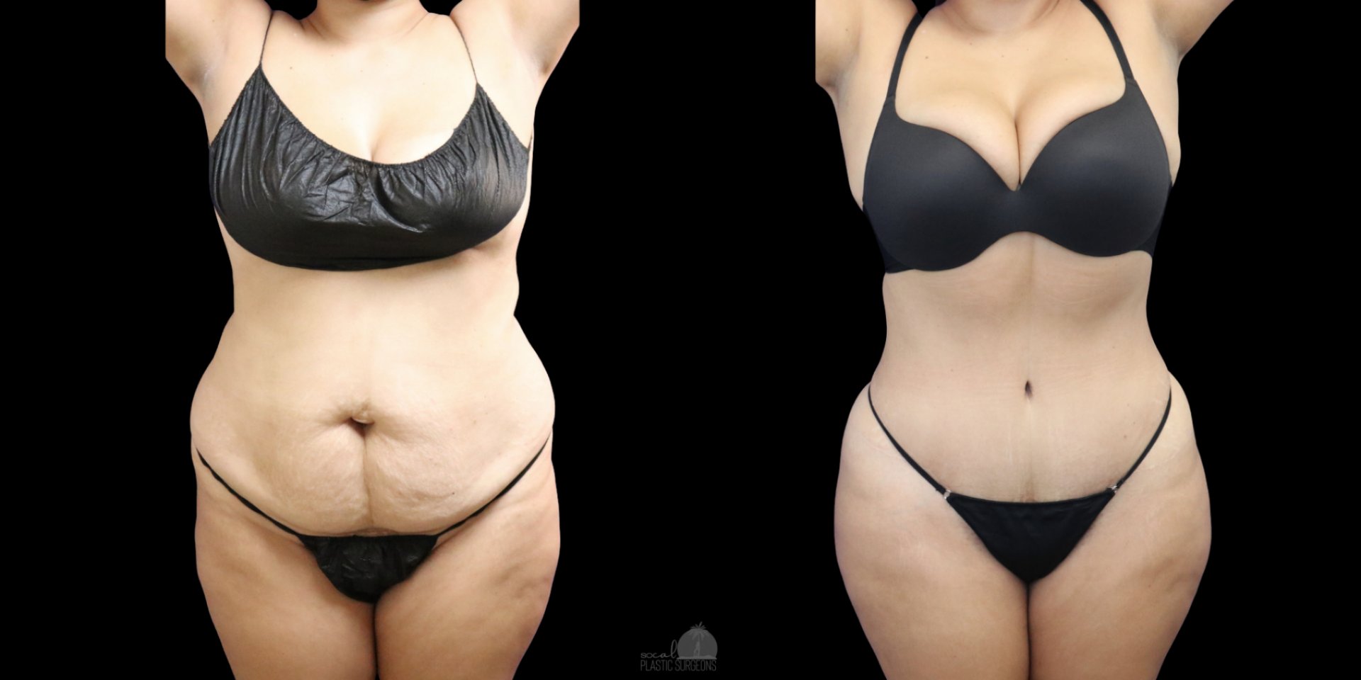 Woman Front view Before and after tummy tuck