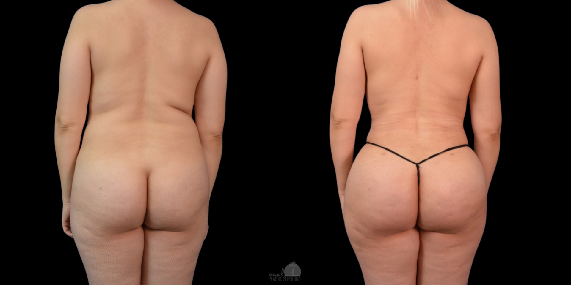 LIPO 360 BEFORE & AFTER and BBL before and after
