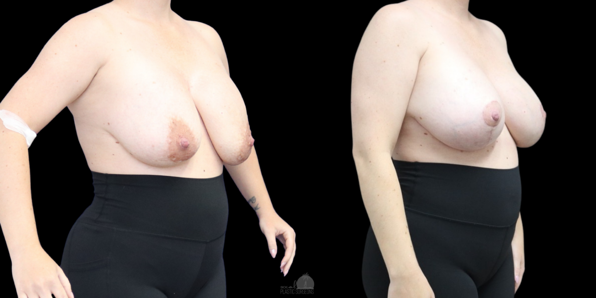 breast augmentation before and after WITH LIFT