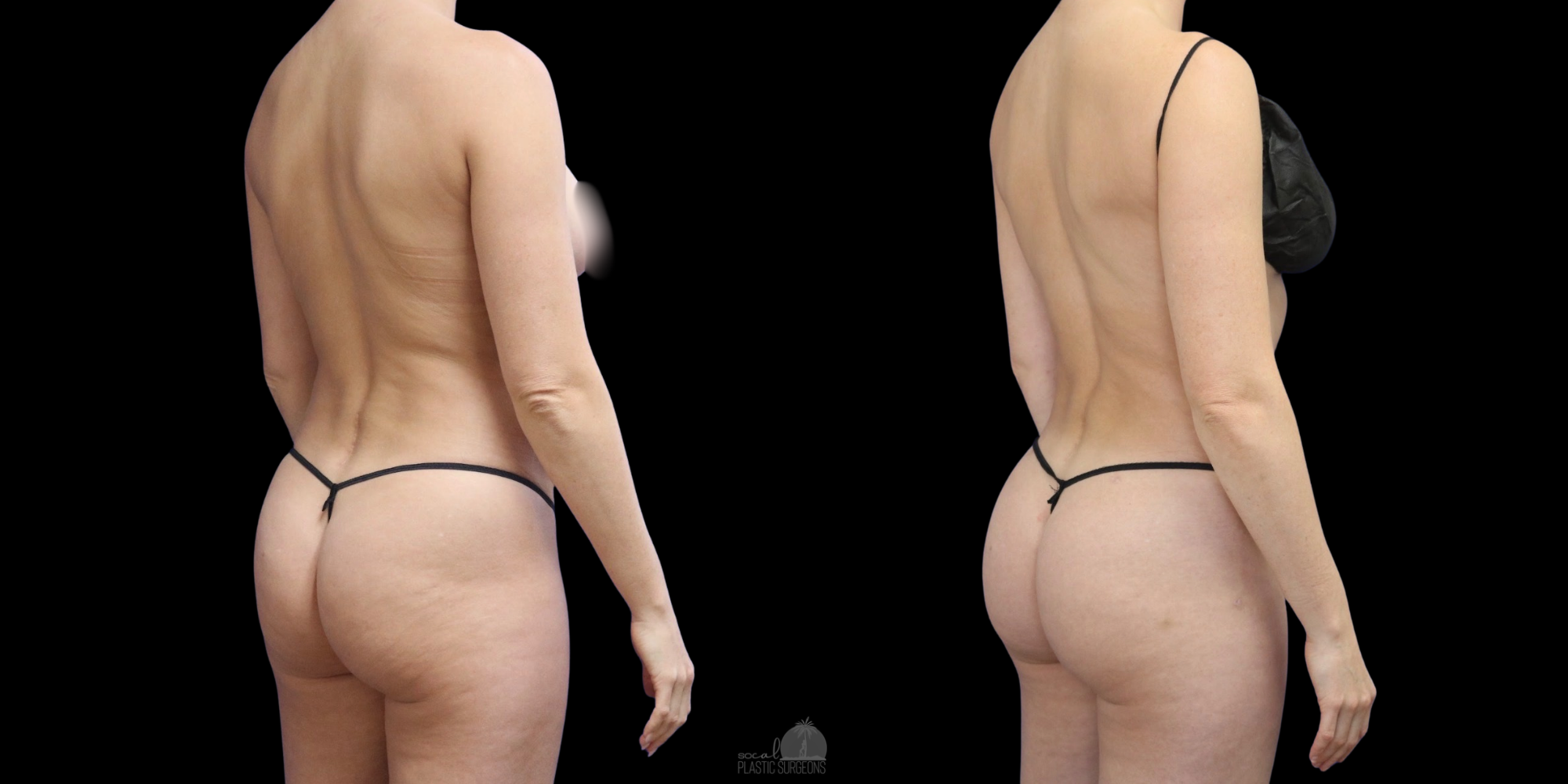 skiny bbl before and after