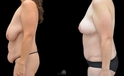 Mommy Makeover Before and after