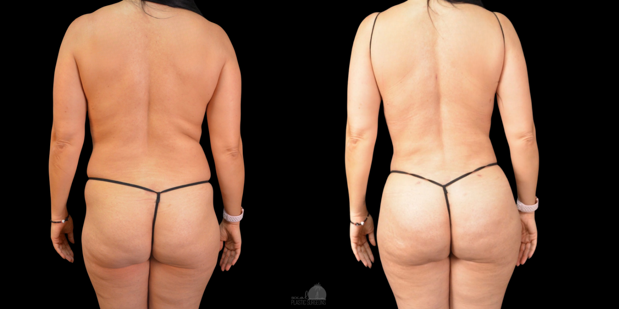 woman before and after Body Contouring
