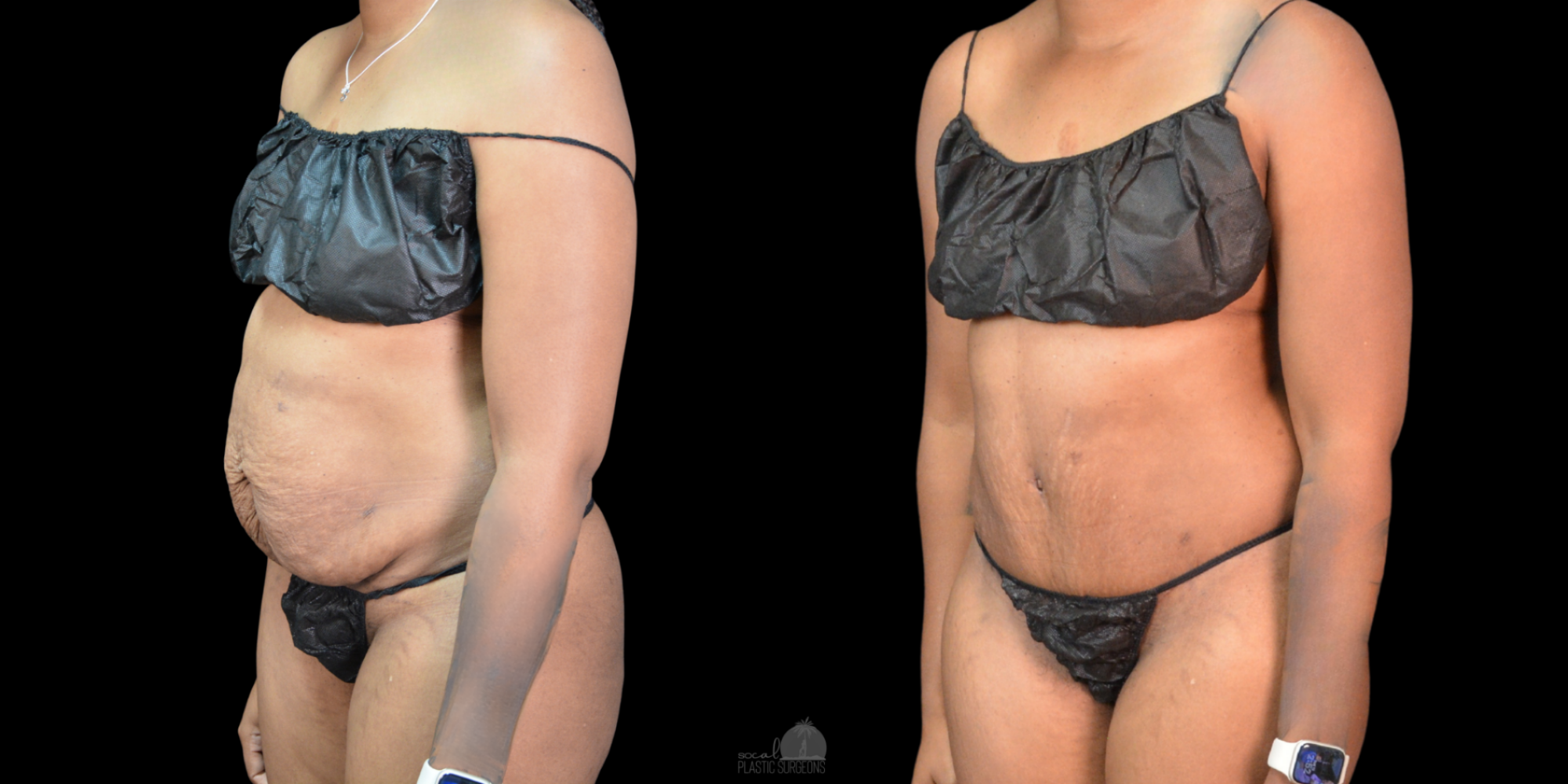 Side-by-side images before and after mommy make over