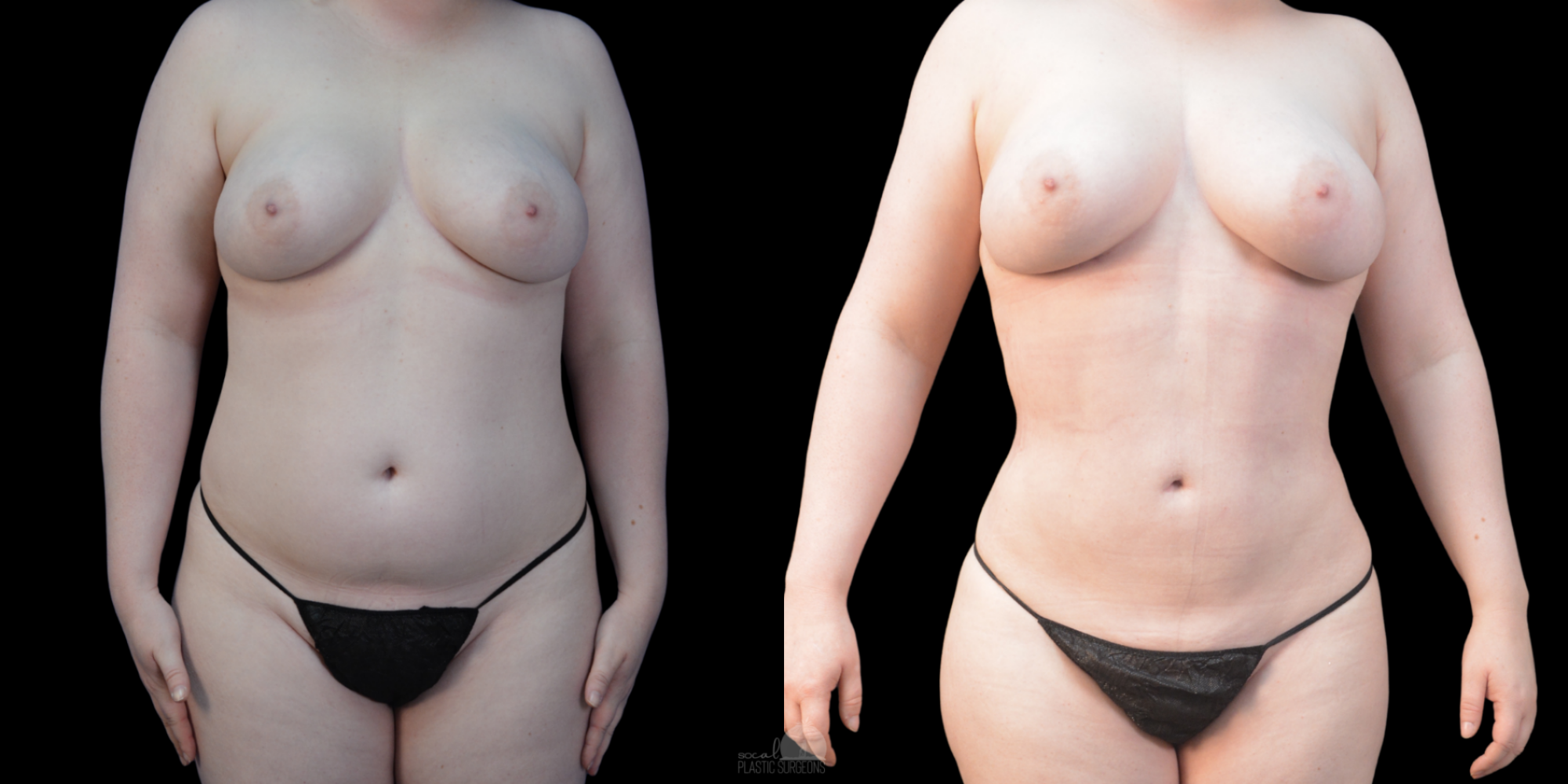 LIPO 360 BEFORE & AFTER and BBL before and after