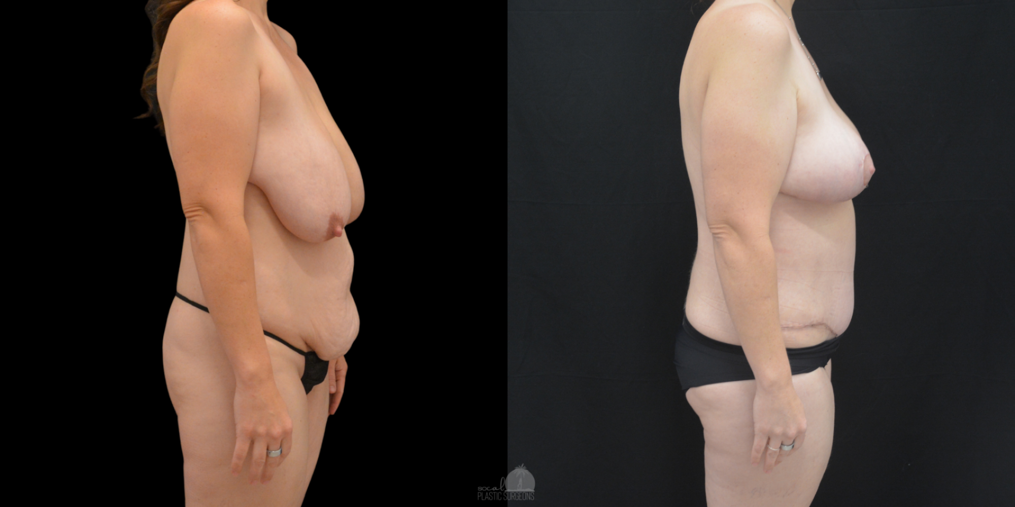 Mommy Makeover Before and after
