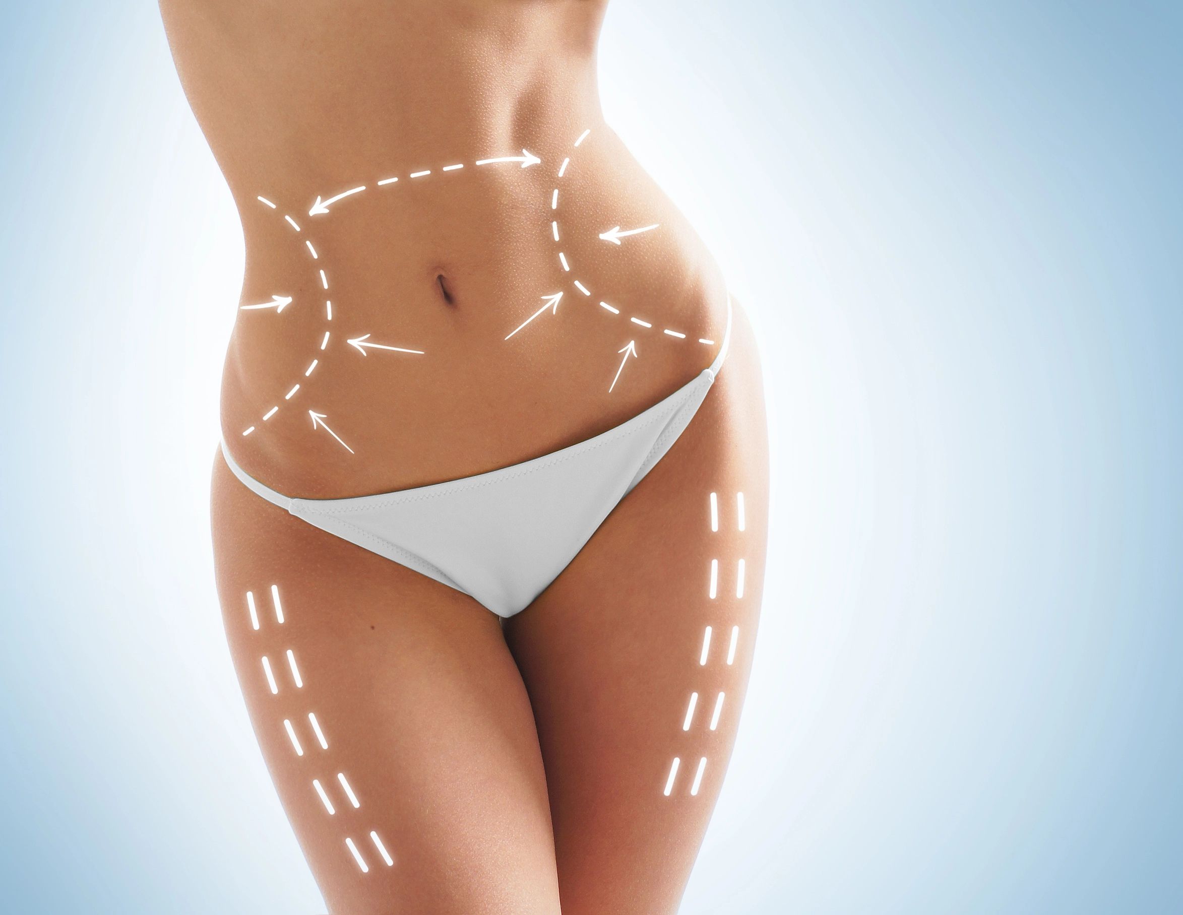 Surgical markings for liposuction on abdomen