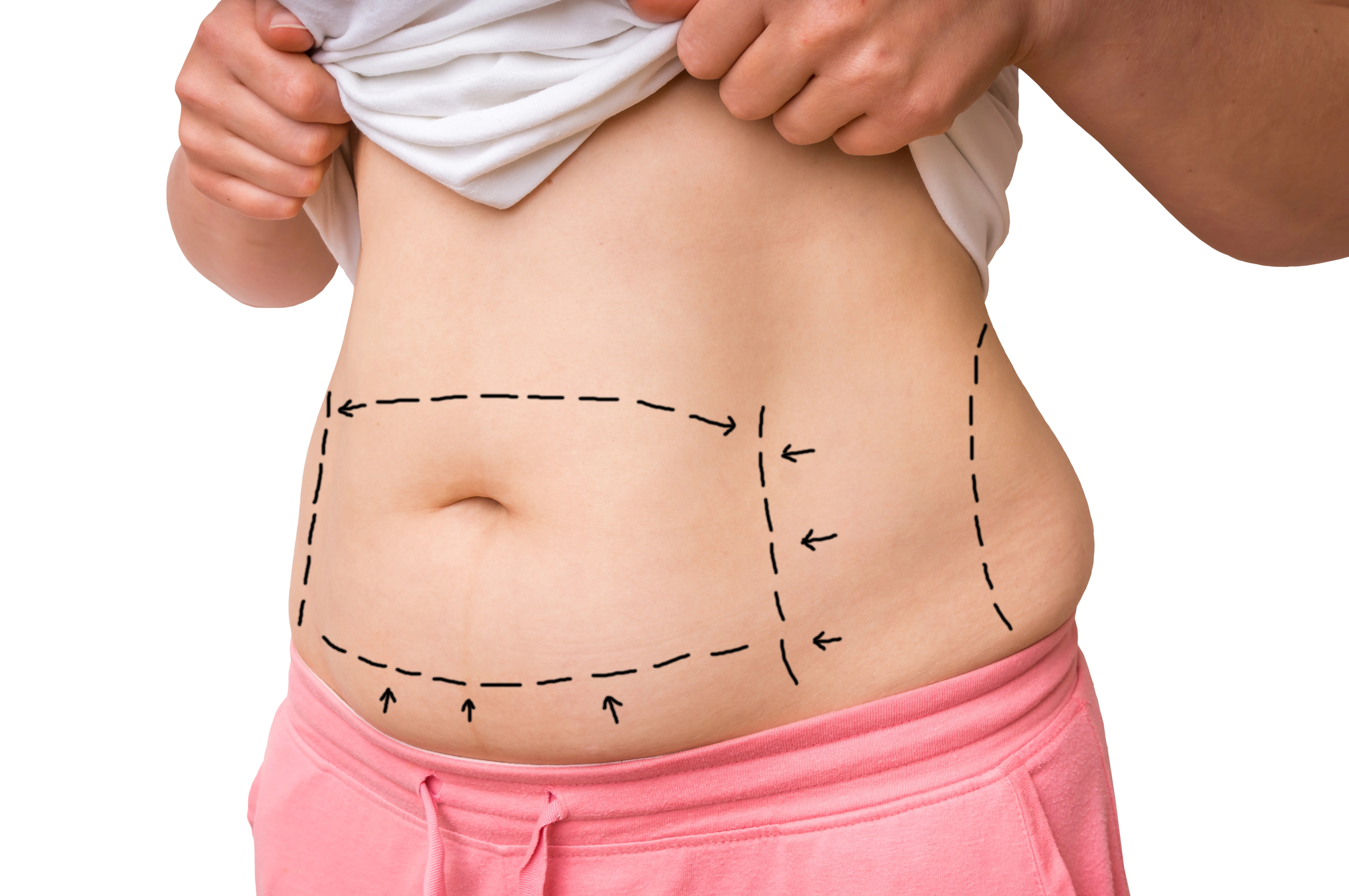 Surgical marks on belly for liposuction