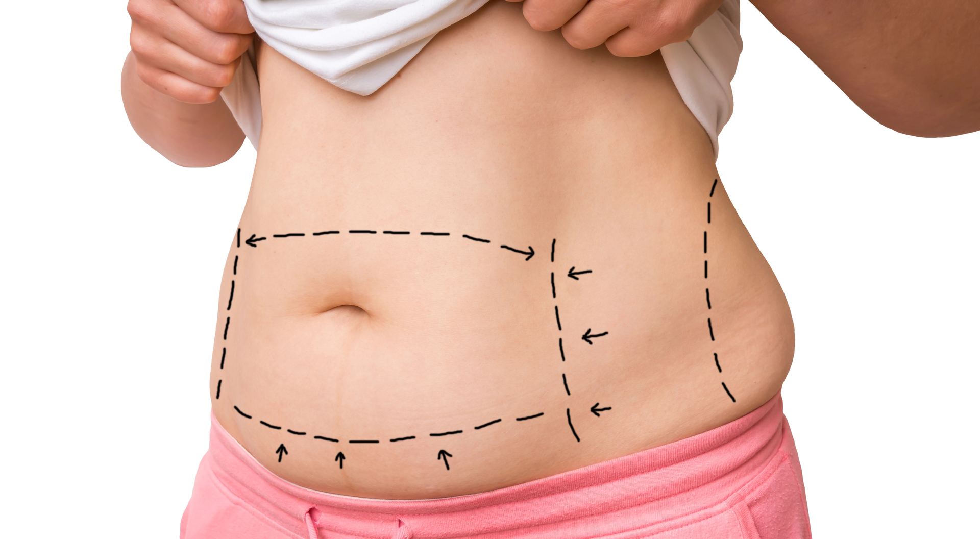 Surgical marks on belly for liposuction