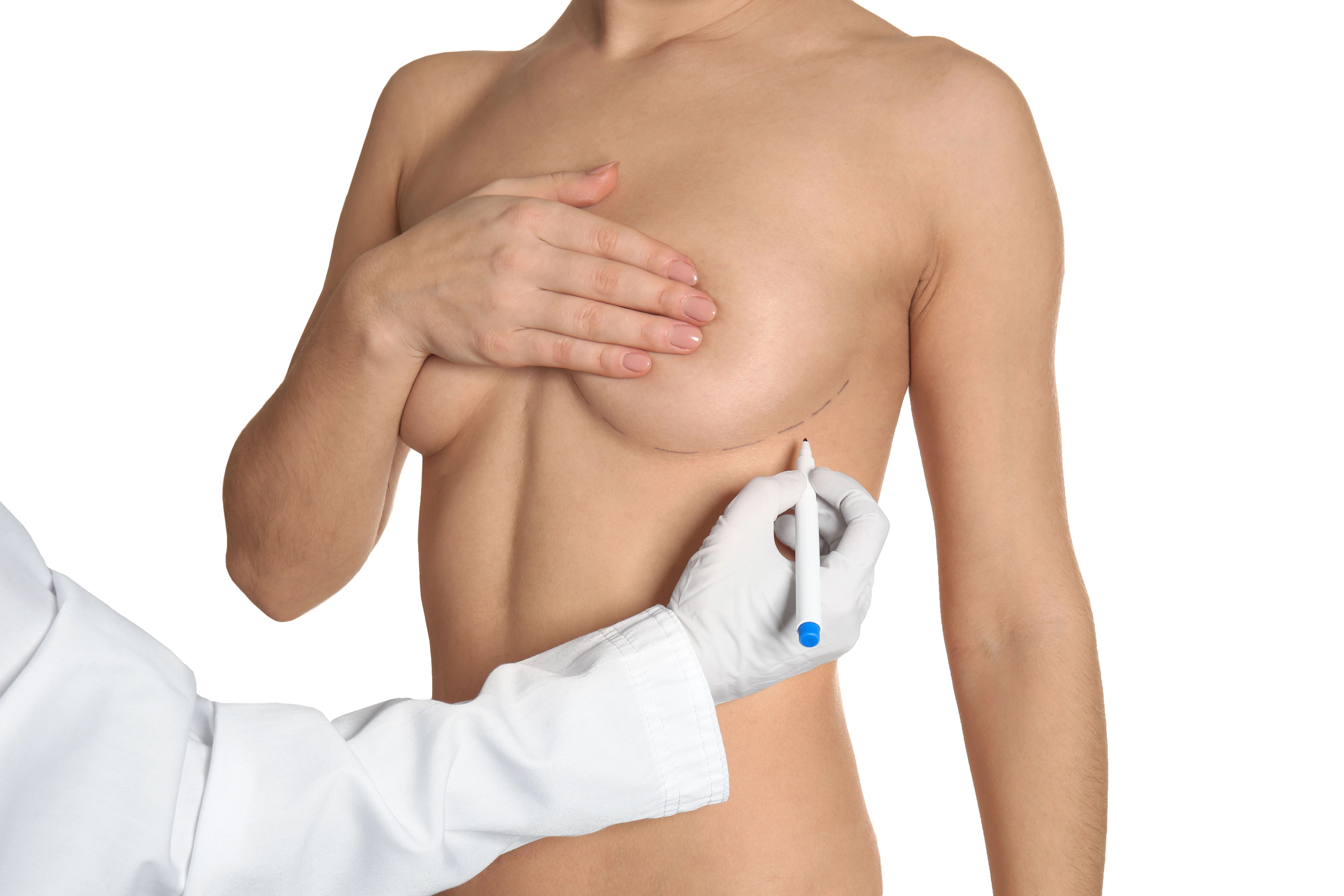 Dr marking below a breast for procedure