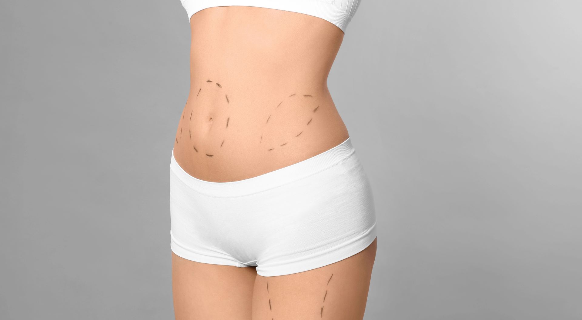 tummy tuck surgical markings