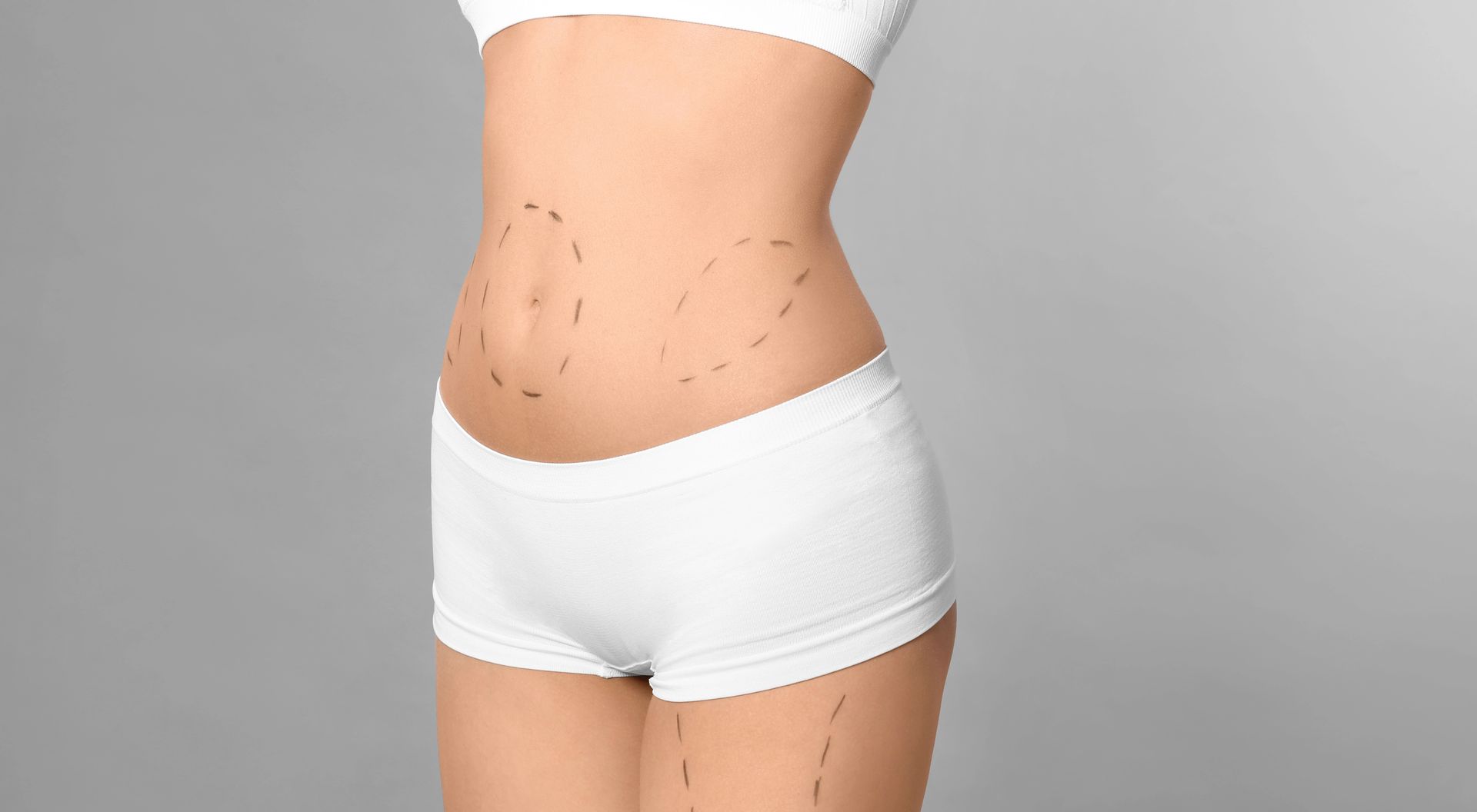 tummy tuck surgical markings