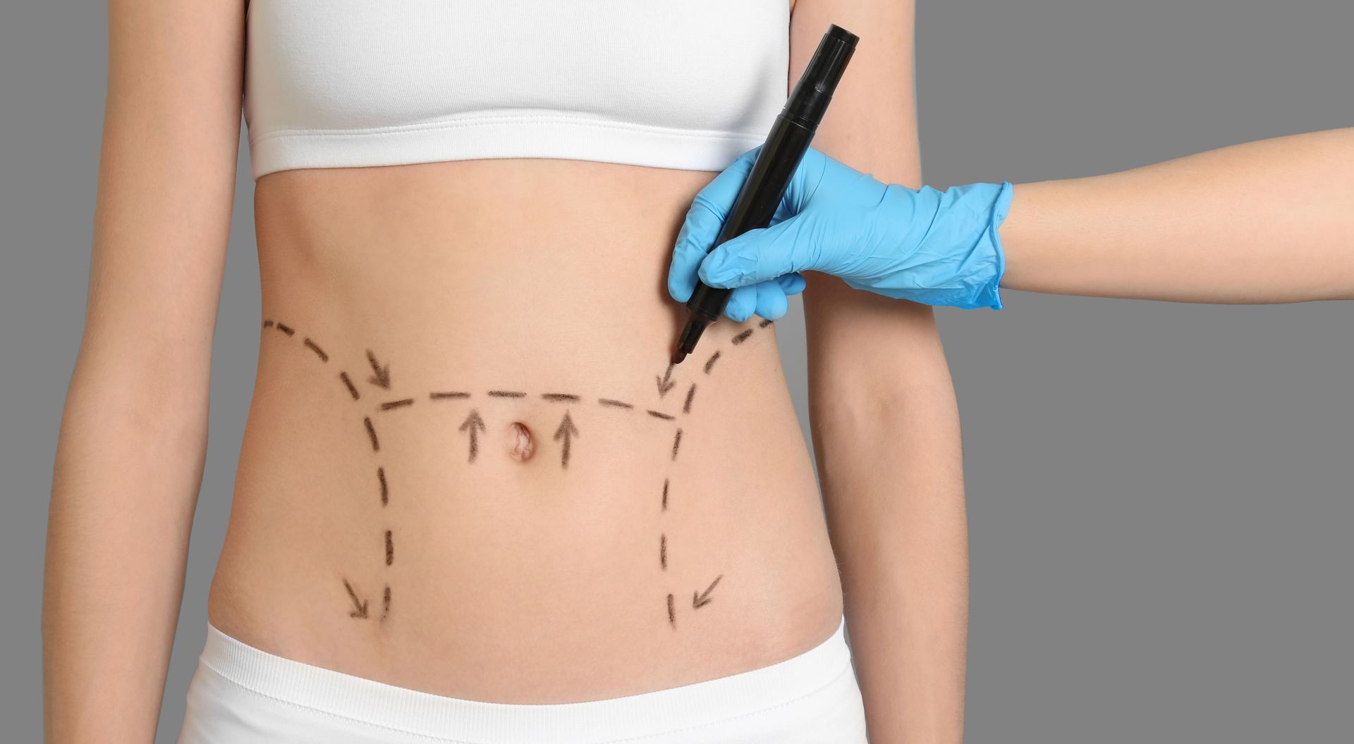 woman with surgical marking for tummy tuck