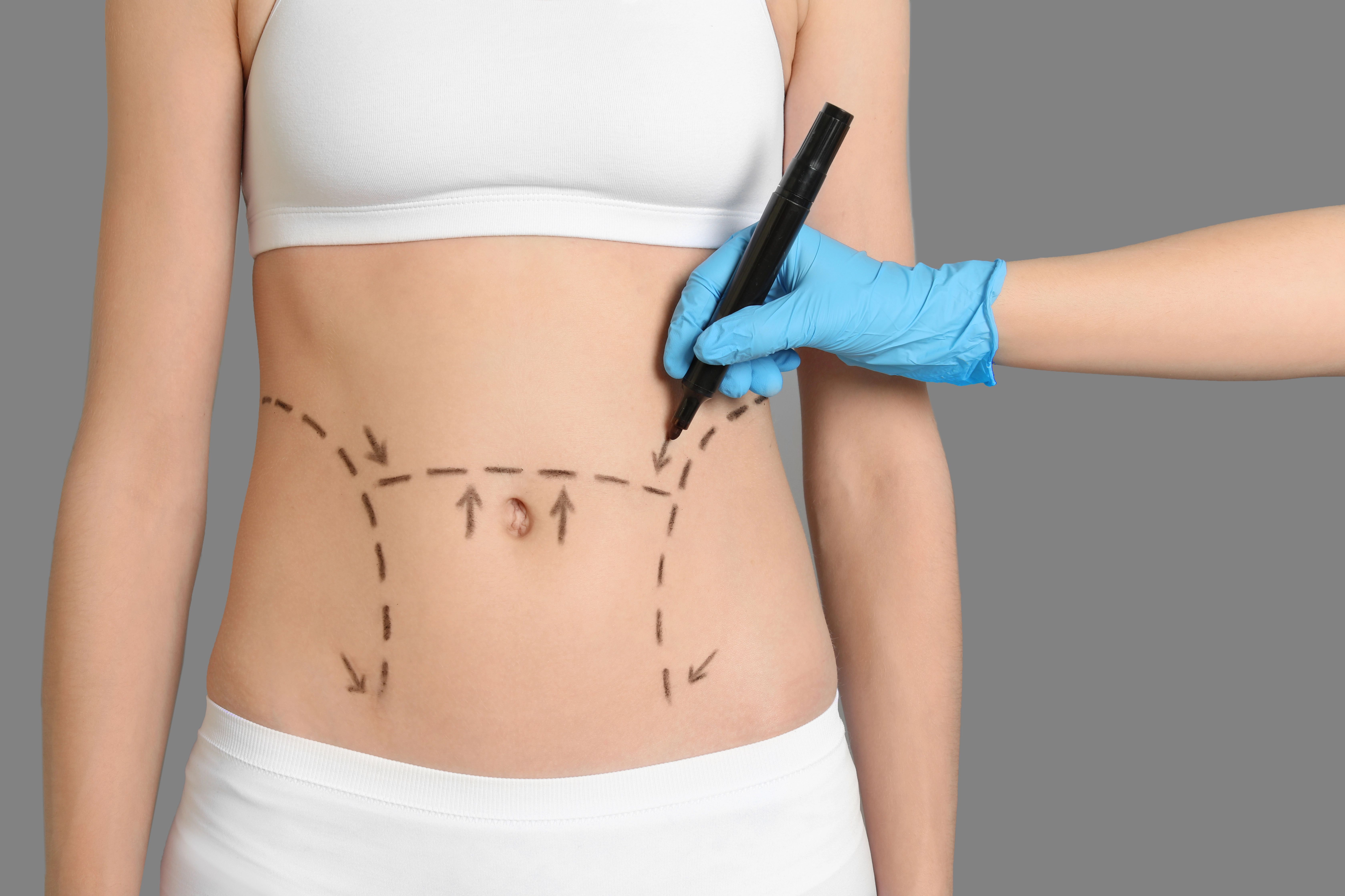 woman with surgical marking for tummy tuck