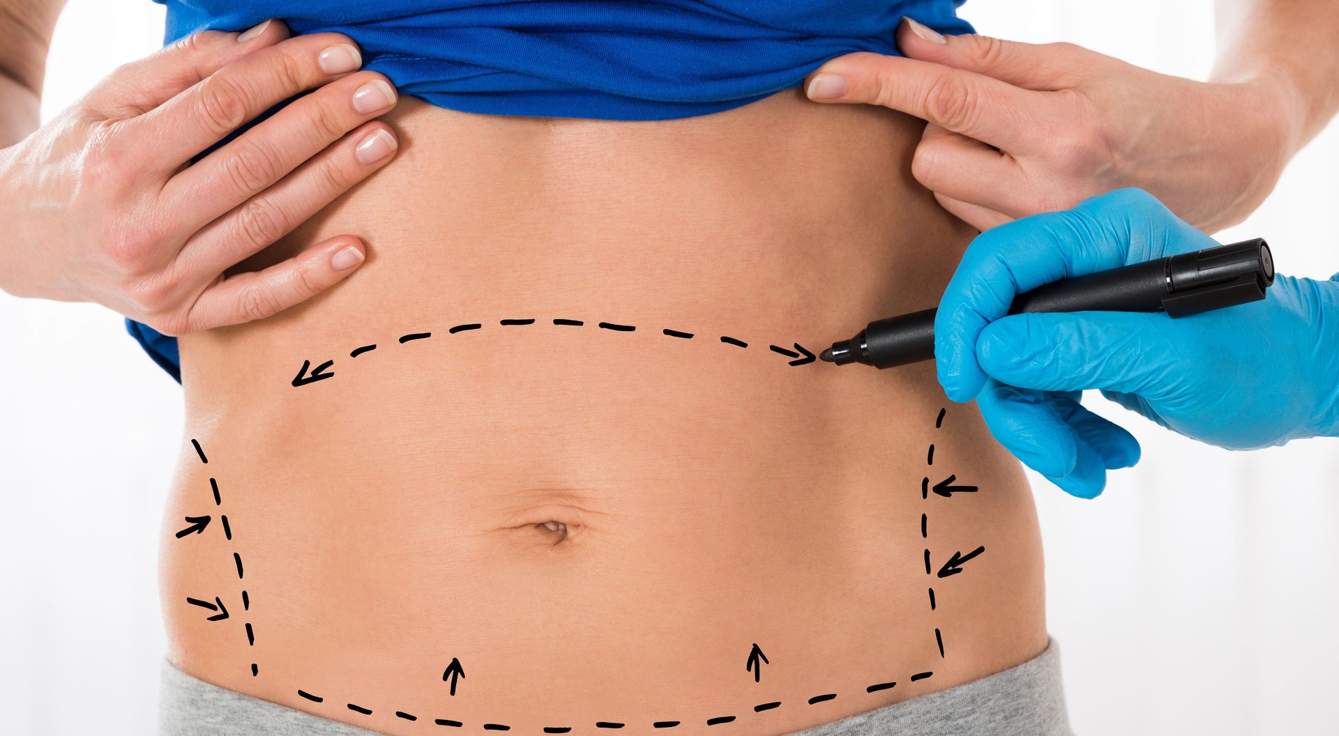 surgical marking on a stomach for tummy tuck