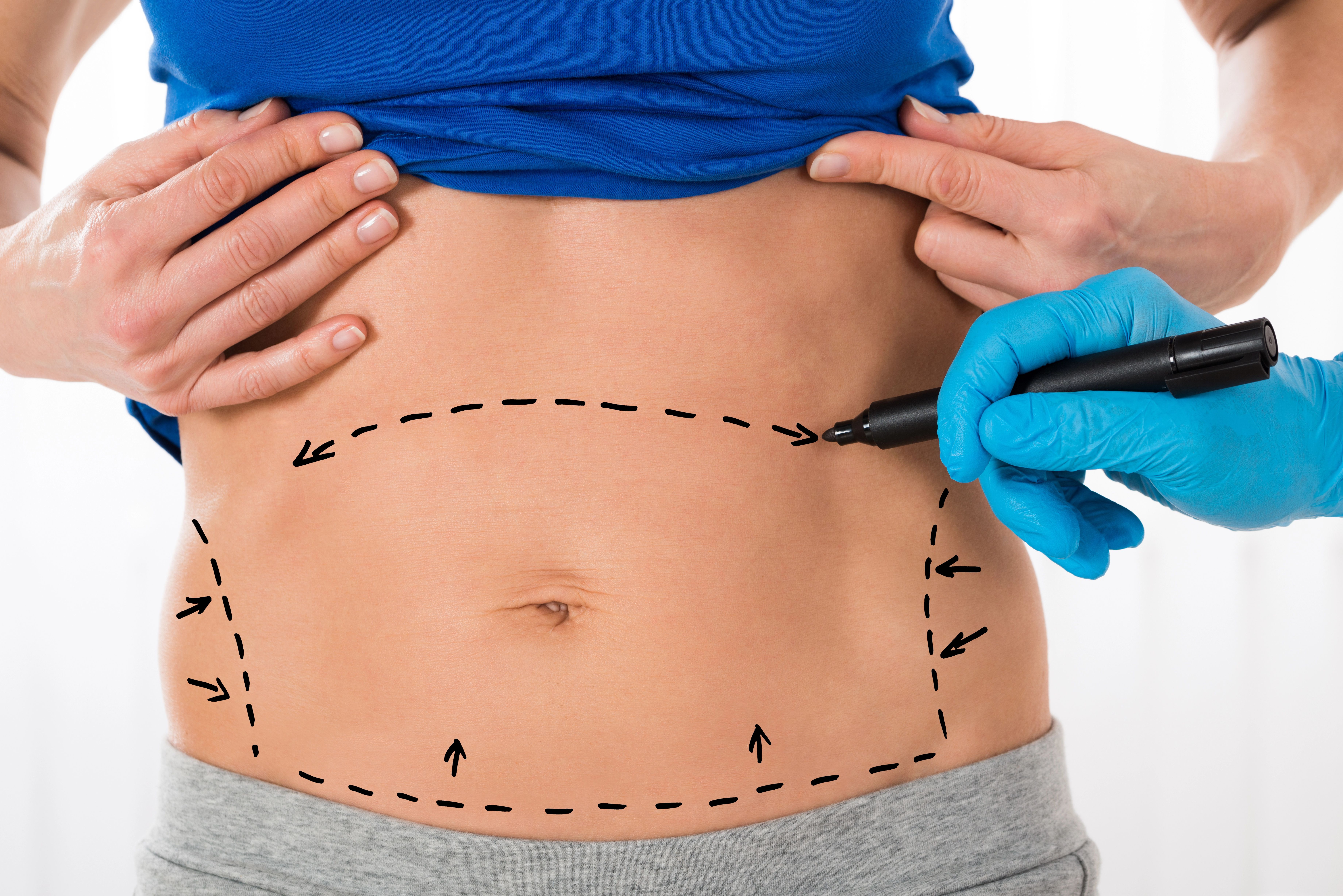 surgical marking on a stomach for tummy tuck