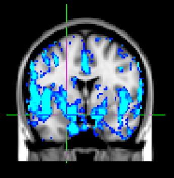 Tiny Blue Dot Foundation | Neural Correlates Fig 2aGraphic