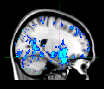 Figure 2. Decreased perfusion in the amygdala after active tFUS of the amygdala. Tiny Blue Dot Foundation | Neural Correlates Fig 2b Graphic