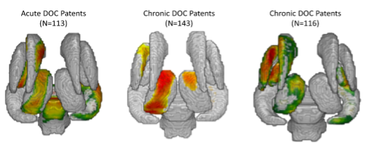 Tiny Blue Dot Foundation | DOC Patients Brain Graphic