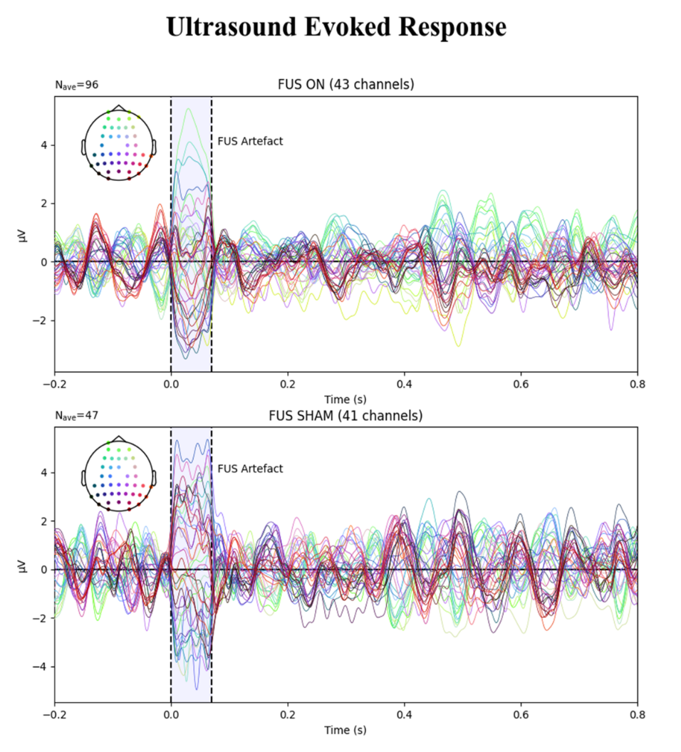 Figure 1. Example brain dynamics response to an ultrasound pulse (top) compared to a sham pulse (bottom). Ultrasound Evoked Potential (top) and the sham session (bottom). Approximately 200 ms after the sonic pulse, a suppression in the brain signal is visible after ultrasound (top) but not after sham (bottom). Tiny Blue Dot Foundation | Ultrasound Evoked Response graph
