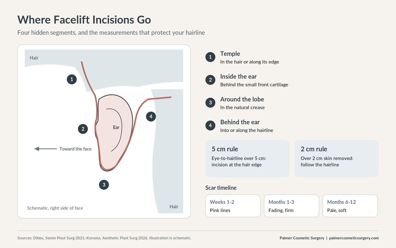 Map of facelift incision placement around the ear and hairline with scar healing timeline