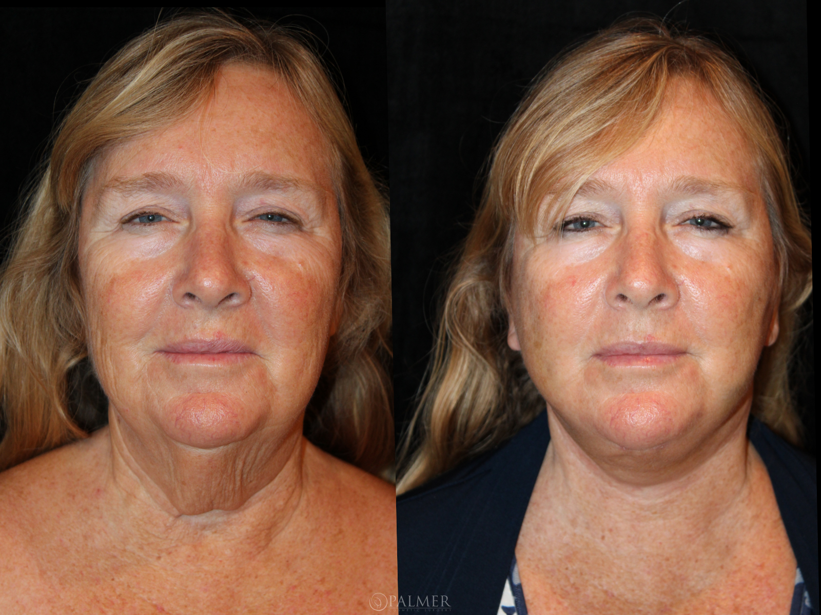 Facelift before and after  Front View