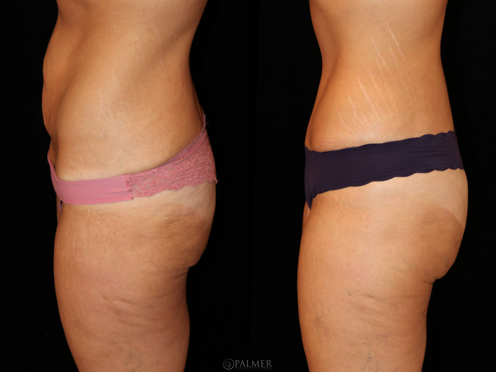 Thigh Lift side  view before and after