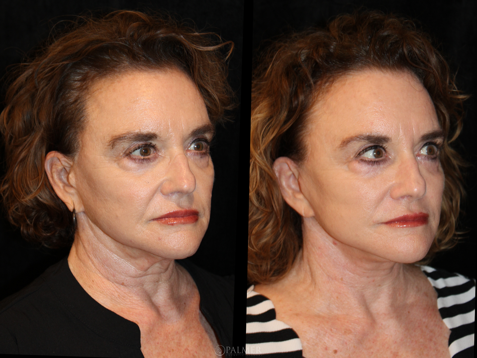 facelift before and after Side View