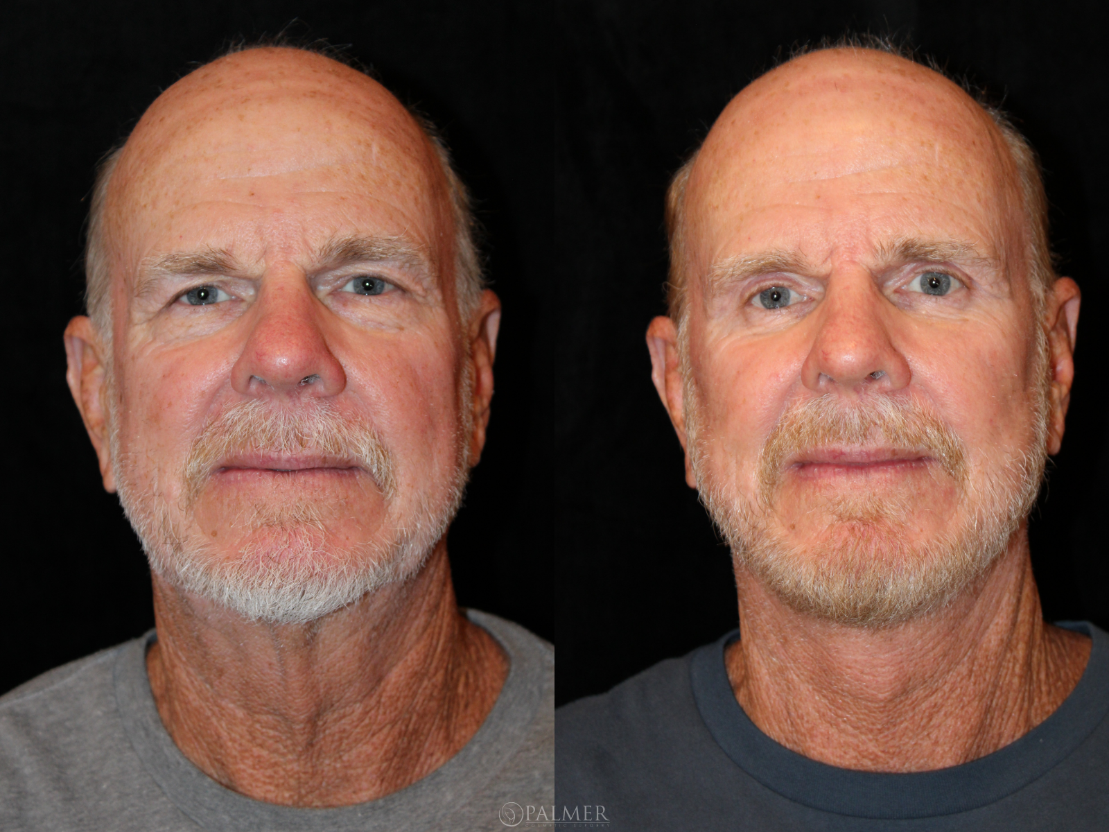 Facelift before and after front view