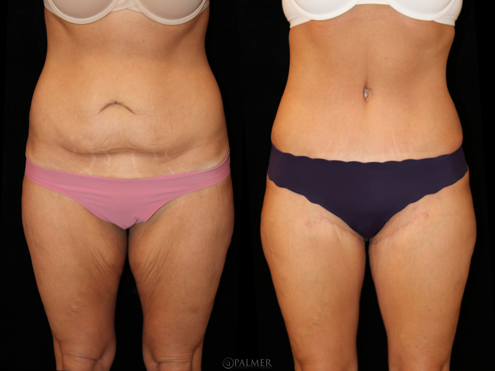 Thigh Lift Front view before and after